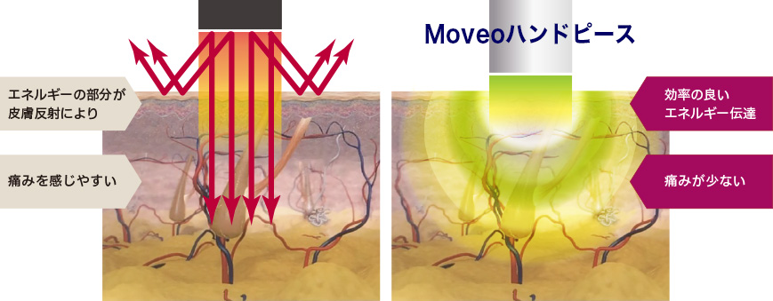 従来のレーザー放出とmoveoハンドピースによるエネルギー損失の違い